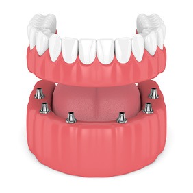 Model of implant-supported denture