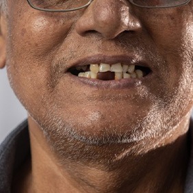 Man has missing teeth