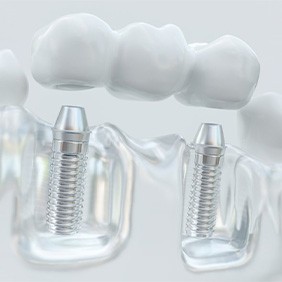 Model of implant bridge