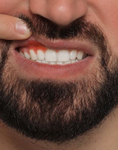 Man lifting his lip to show red, swollen gums