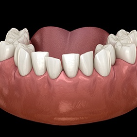 Artistic rendering of a crooked set of lower teeth
