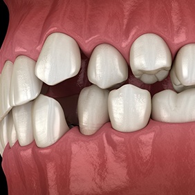 Rendering of a profile view of front teeth not touching when the back teeth are closed together