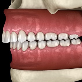 Rendering of a profile view of crooked and gapped teeth