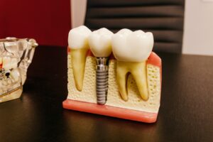 Dental implant model on desk